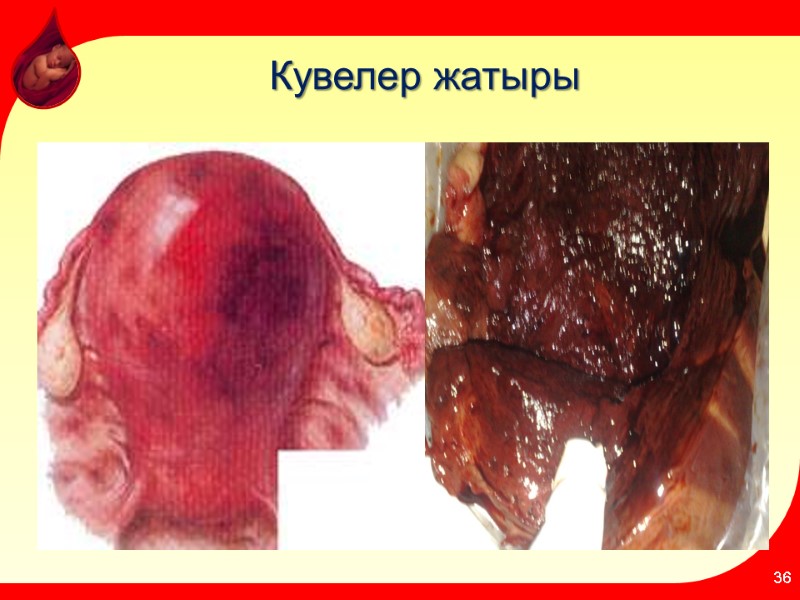 Кувелер жатыры 36